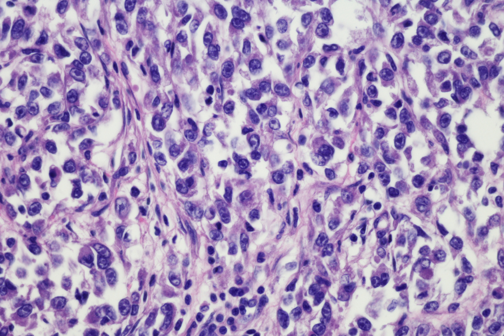 Diagoni sarcomi - Immagine istologica di un sarcoma a cellule chiare della gamba: i nidi di cellule tumorali con citoplasma chiaro e nucleoli evidenti sono circondati da denso stroma fibroso. Questo tipo di sarcoma insorge nei tessuti connettivi come muscoli, tendini o ossa.